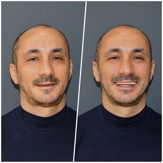 platinum-dental-turismo-dentale-in-albania-4 (2)